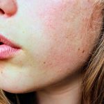 5 rețete de casă în tratare de acnee