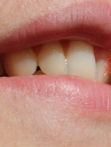 Zubný kaz na mliečnych zuboch